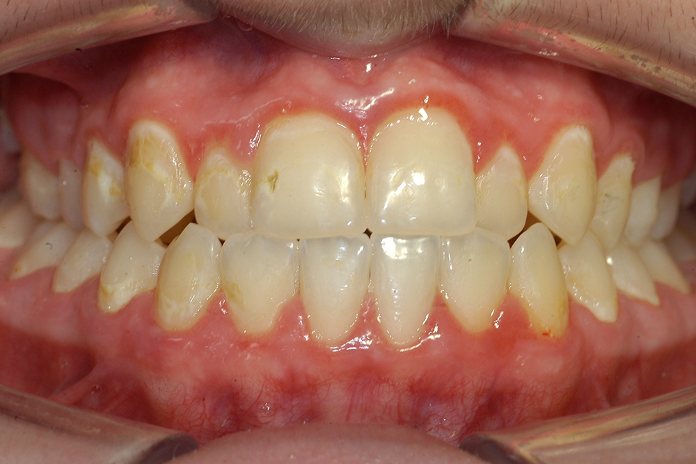 Entkalkte Zähne